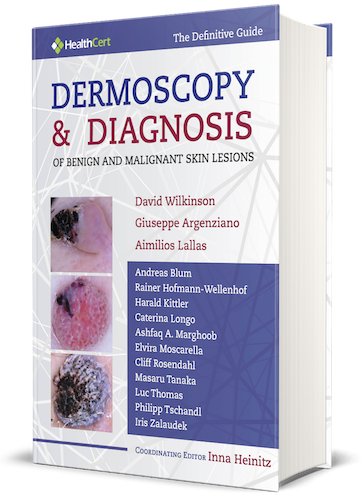 Dermoscopy and Diagnosis